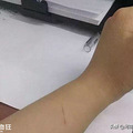 被狗舔舐两个月后，卫辉9岁男孩竟狂犬病发，不幸身亡！_2