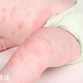 宝宝过敏怎么办？这些应对方式快学习_0