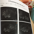 子宫肌瘤成了我备孕路上的拦路虎，差点让我贴上了不孕标签！_3