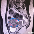 子宫肌瘤成了我备孕路上的拦路虎，差点让我贴上了不孕标签！_2