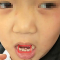 孩子长了双排牙，到底需不需要拔？