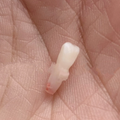 Pouch餐椅存在安全隐患！！10个月宝宝没了牙！！！_0