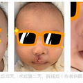 孕18周的时候体检出宝宝是兔唇，出生后两周内就做了正畸手术_4