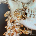 男子因疼痛拔智齿竟发现患癌