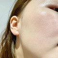 玫瑰痤疮是可以恢复的！被折磨了7年，我做了这些医美后明显改善
