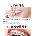 牙齿矫正2年多，颜值真的有提高，你想知道的功课都在这！_5