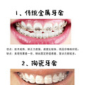 牙齿矫正2年多，颜值真的有提高，你想知道的功课都在这！_4