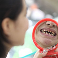 万元的3D牙齿美容    几天后发现自己变怪物（图）