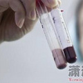 男子抽出乳白色血液 称喜欢用油汤拌饭吃