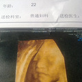 鉴定宝宝多半是男孩，27周+2天 发现脐带绕颈一周_0