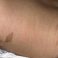 揭开胎记的秘密 哪些会对孩子产生危害？_5