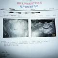 四维归来，前年胎停