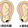 胎位不正怎么纠正
