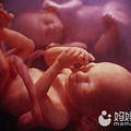 脐带绕颈一周怎么办？准妈妈们日常生活就要注意！