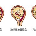 胎盘低是怎么回事？听说有点危险！