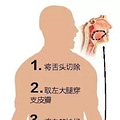 【居然真可以】舌头没了！医生从他腿上割块肉移进嘴里……