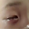 5岁男童玩干燥剂把眼睛炸伤 眼珠被溶解(图)