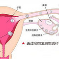 卵泡监测  医学检查卵泡异常