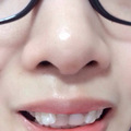 刚在杭州做了隐形矫正，感觉很不错，梦寐以求的美牙