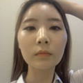 脸大毁一生，发个贴给大家一点勇气，看看我磨骨的效果_0