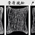 骨质疏松常见认识误区


骨质疏松一直被