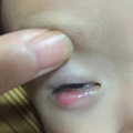 散粒肿怎么治