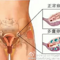 昆凌二胎了，同是多囊的你，应该知道些啥？_0