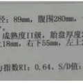 B超单上的羊水指数是什么？多少算正常？