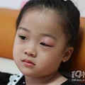 两岁宝宝眼睛起散粒肿怎么办？如何预防散粒肿？_3