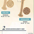 每3秒就有一起因骨质疏松引发的骨折_2