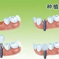 杭州种牙现在多少钱一颗？