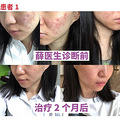 不想再反复长痘？做对这件事很关键_3