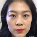 张学艳院长不开刀去眼袋真实案例分享_0