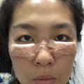 张学艳院长不开刀去眼袋真实案例分享_1