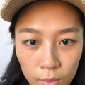 张学艳院长不开刀去眼袋真实案例分享_3