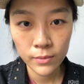 张学艳院长不开刀去眼袋真实案例分享_2