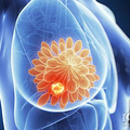 【名医说】频繁按摩按出乳腺癌？这些乳房知识你真的应该收藏_5