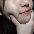 【名医说】年轻人才长痘？喝牛奶长痘？痤疮真相大揭秘_1