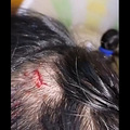 因为一根普通的头绳，孩子头上缝了4针！杭州宝妈后悔不已：再也_3