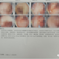 不便秘不腹泻，37岁女子突然便血，一查竟是肠癌！_0