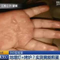 被可乐炸伤，脸缝 38 针， 夏天的 70 个致命隐患要当心_4