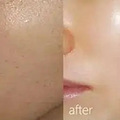水光针的成分是什么东西、水光针打了多久看到效果、释怀了~_4