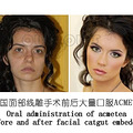 全脸线雕有什么危害、吃瓜群众快看脸部线雕的副作用和危害~_4