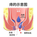 根除痔疮最好的办法，竟然是……（不是提肛）_1