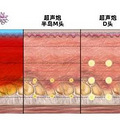 超 声炮做完什么时候有效果，超 声炮做完要注意什么你了解吗~_0