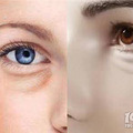割眼袋手术多久可以正常上班、做眼袋手术多长时间能恢复~_2