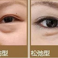 割眼袋手术多久可以正常上班、做眼袋手术多长时间能恢复~_0