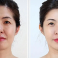 妈呀、线雕3个月脸越来越大怎么办、面部线雕的副作用和危害~_2