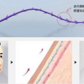 妈呀、线雕3个月脸越来越大怎么办、面部线雕的副作用和危害~_1