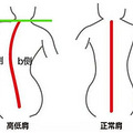 让孩子更“正直”！脊柱侧弯要早发现、早纠正_1